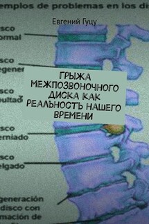 Грыжа межпозвоночного диска как реальность нашего времени - Евгений Гуцу